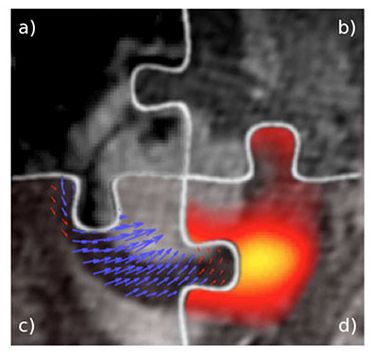 Complementary information from multi-modality imaging can provide an accurate assessment of different aspects of a myocardial infarction: a) LGE MRI shows non-viable tissue. b) Cine MRI evaluates global heart function. c) DENSE MRI interrogates local muscle performance, and d) PET is used for cell viability by monitoring metabolism.